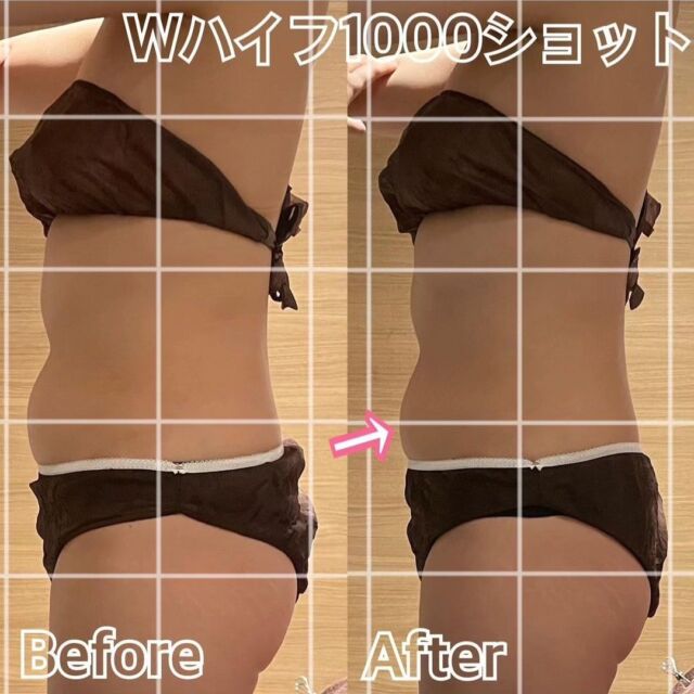 【Wハイフ 1000ショット】
60分　¥22000

超音波で脂肪にアプローチするハイフを2台使用。

焦点型ハイフで、ガチガチかための脂肪にピンポイントにアタック！
その後は連射型ハイフで周りの脂肪にアプローチ。
短時間でもお肉の厚みの変化や
柔らかさをご実感いただけます(^_^)
ほぼ痛みがないので、痛がりさんでもお試しいただきやすいです🌸

部分痩せが気になる方はぜひお試しくださいませ。

GINZACLEAR銀座本店　☎️03-6274-6952 

#銀座
#ginza
#コルギ
#korugi
#骨気
#小顔 
#エステ 
#GINZACLEAR
#小顔になりたい 
#小顔矯正 
#小顔マッサージ 
#小顔効果 
#小顔サロン 
#小顔エステ 
#小顔美人 
#korugitokyo
#骨気東京
#コルギ東京
#東京コルギ
#コルギマッサージ 
#骨気マッサージ
#コルギサロン 
#骨気サロン 
#コルギエステ 
#骨気エステ
#エンビロン
#ヘッドマッサージ
#ソノケア
#ハイドラ
#ハイパーナイフ