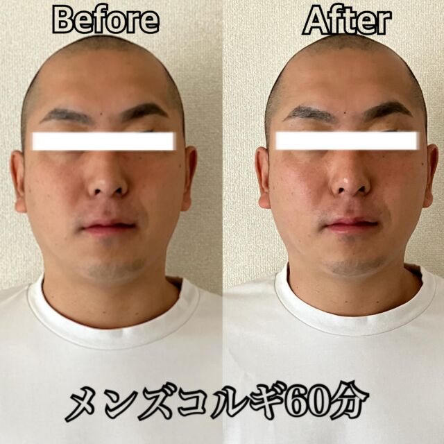 【メンズ 小顔コルギ60分】
初回¥13500

男性にも人気なCLEARの小顔コルギ。

お顔がコンパクトになるだけでなく、
パソコンやスマートフォンの使用による眼精疲労
食いしばりによる顎の張り感も一緒に改善していきます♪

頭皮ケアもセットになっているので、施術後には頭もスッキリとした感覚を味わって頂けます。

是非一度銀座CLEARの小顔コルギお試しください。

GINZACLEAR銀座本店 03-6274-6952 
#銀座
#ginza
#コルギ
#korugi
#骨気
#小顔 
#エステ 
#GINZACLEAR
#小顔になりたい 
#小顔矯正 
#小顔マッサージ 
#小顔効果 
#小顔サロン 
#小顔エステ 
#小顔美人 
#korugitokyo
#骨気東京
#コルギ東京
#東京コルギ
#コルギマッサージ 
#骨気マッサージ
#コルギサロン 
#骨気サロン 
#コルギエステ 
#骨気エステ
#エンビロン
#ヘッドマッサージ
#ソノケア
#ハイドラ
#ハイパーナイフ